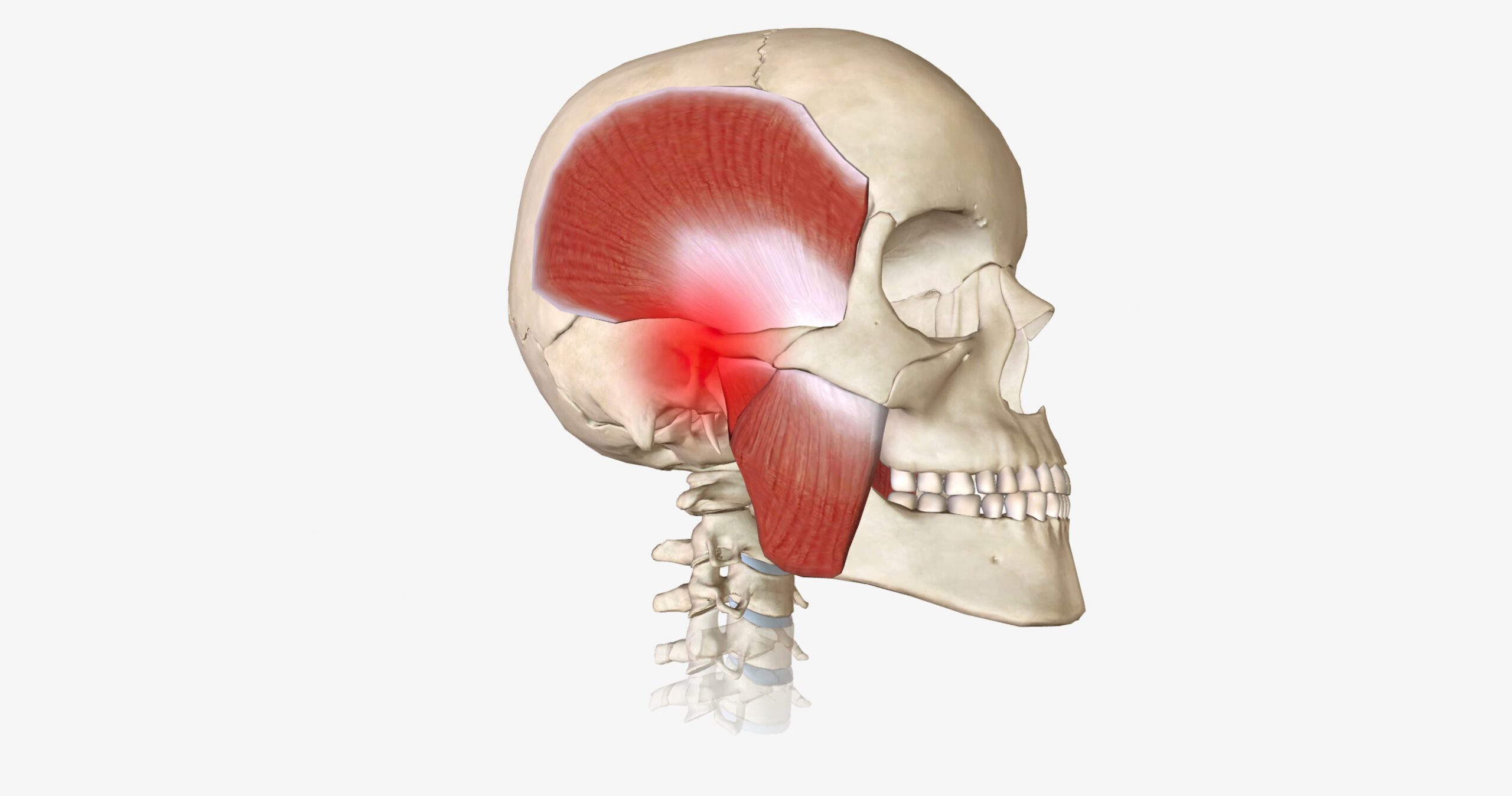 bruxismo-es-trastorno-caracterizado-desgaste-anormal-dientes-debido-al-rechinar-apretar-musculos-mandibula